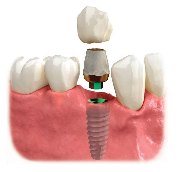 Mão răng sứ không đạt chuẩn là nguyên nhân dẫn đến trồng Implant bị nhức