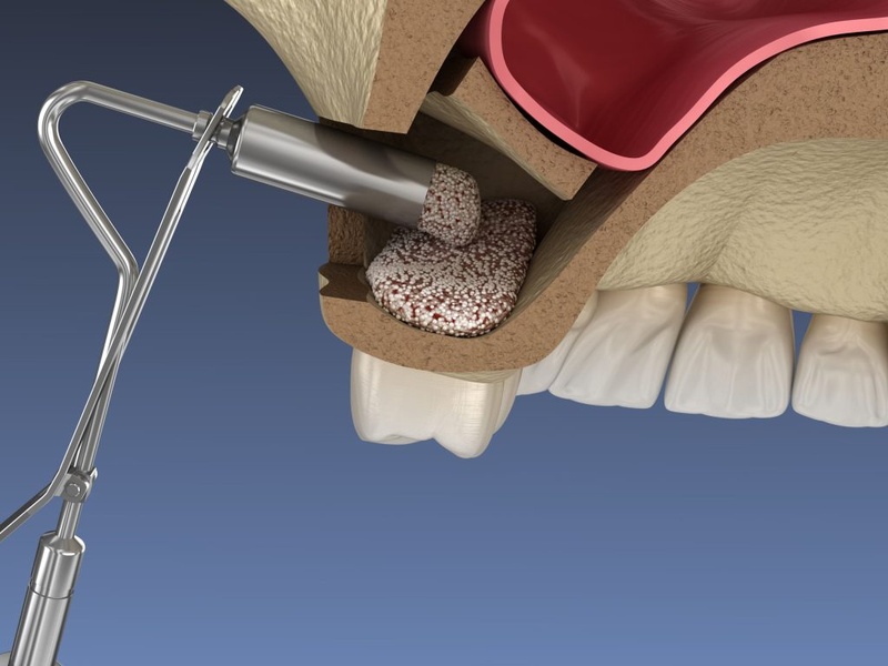 Nâng xoang tạo thêm không gian để cấy ghép Implant