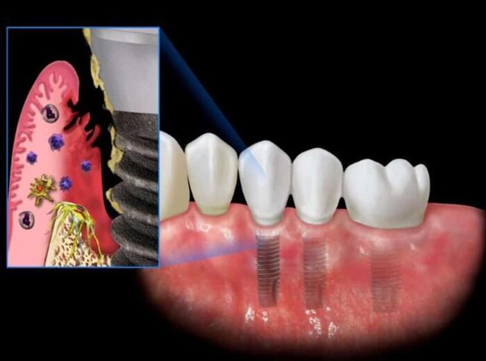 Implant giá rẻ gây nhiễm trùng vùng cấy Implant