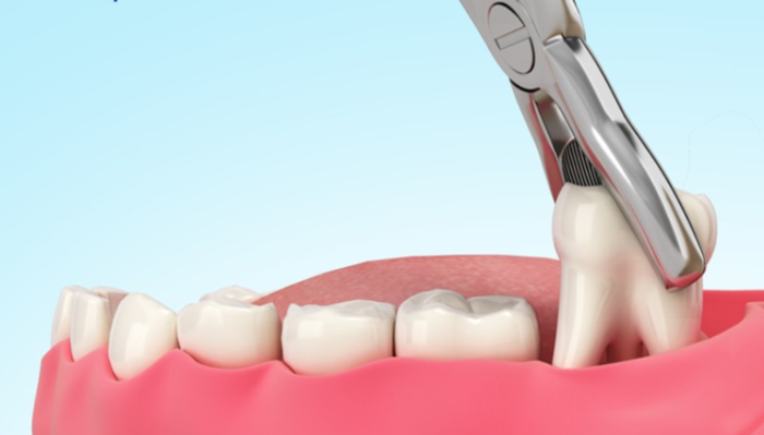 Nhổ răng khôn là một tiểu phẫu trong nha khoa
