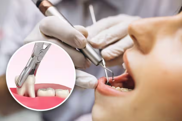 Nhổ răng khôn bằng phương pháp truyền thống