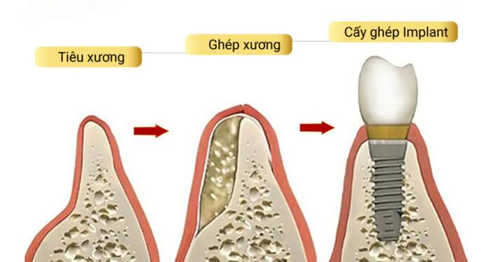 Ghép xương hàm là bước quan trọng trong quy trình cắm Implant khi tiêu xương hàm