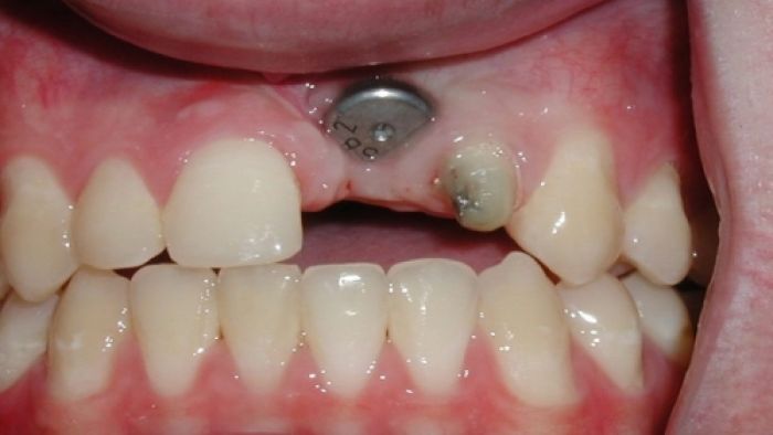 Răng cắm Implant bị lệch do kỹ thuật thực hiện