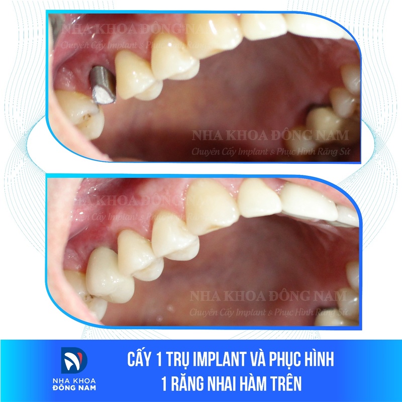 Răng Implant có thẩm mỹ và chức năng không khác biệt so với răng tự nhiên