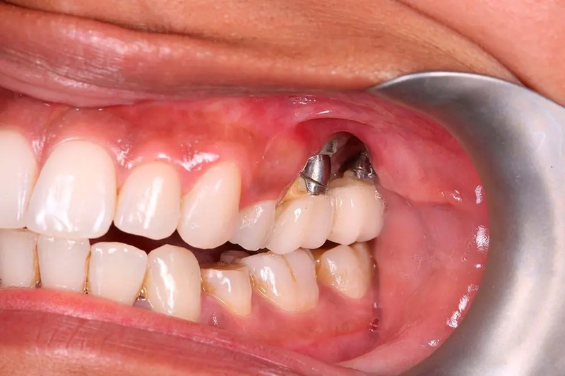 Rủi ro nếu cấy Implant khi tiêu xương không đúng kỹ thuật
