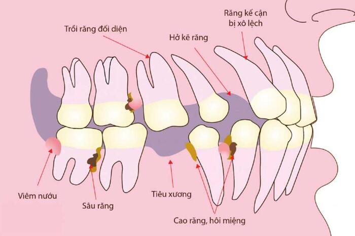 Tiêu xương hàm ảnh hưởng nghiêm trọng đến sức khỏe và thẩm mỹ