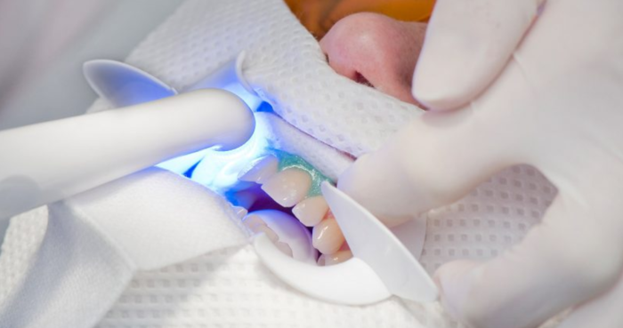 Tẩy trắng răng bằng công nghệ Zoom Whitening