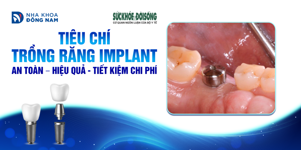 Tiêu chí trồng răng Implant an toàn tiết kiệm