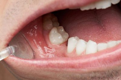 Tiêu xương hàm có thể khắc phục bằng phương pháp cấy Implant