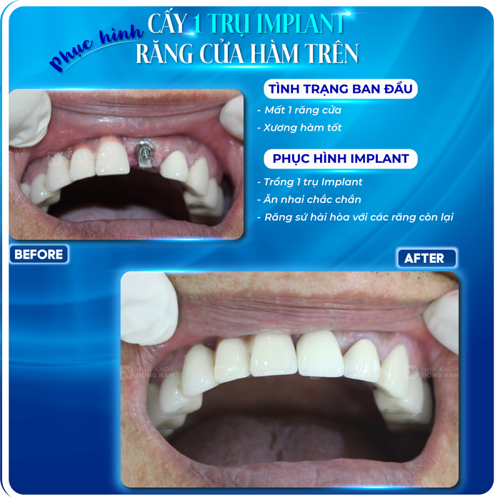 Kết quả phục hình Implant của khách hàng tại Nha khoa Đông Nam