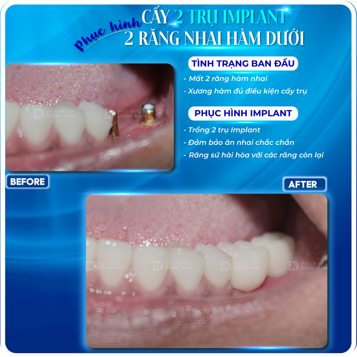 Phục hình Implant răng nhai
