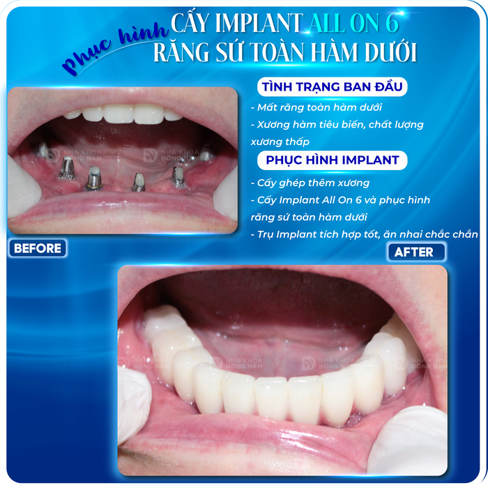 Khách hàng trồng răng Implant All-on-6 hàm dưới