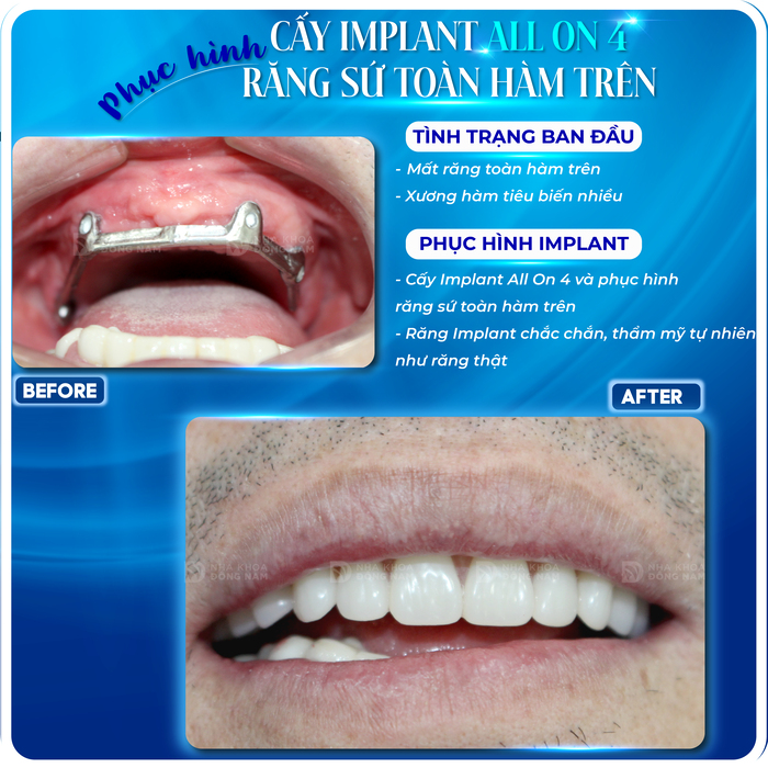 Khách hàng trồng răng Implant All-on-4 hàm trên