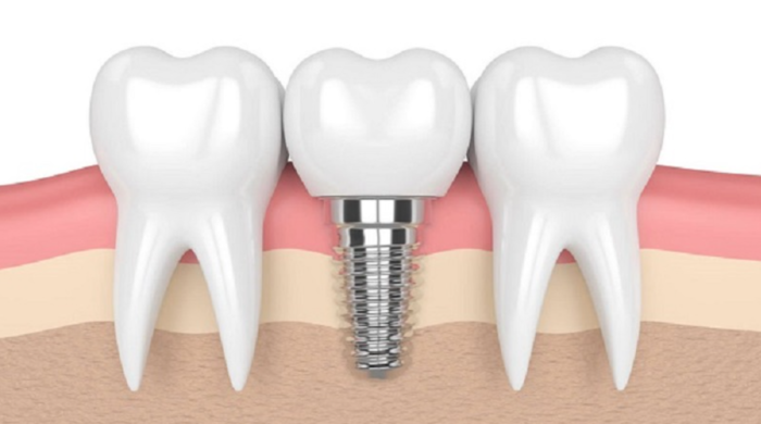 Dịch vụ trồng răng Implant giúp giảm áp lực tài chính cho khách hàng