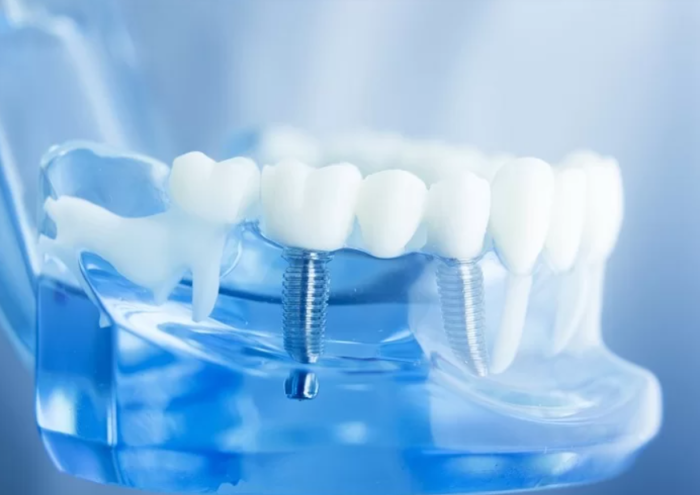 trồng răng implant trả góp