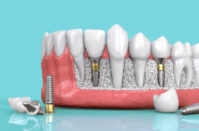 Thủ tục dịch vụ trồng răng Implant trả góp rất đơn giản