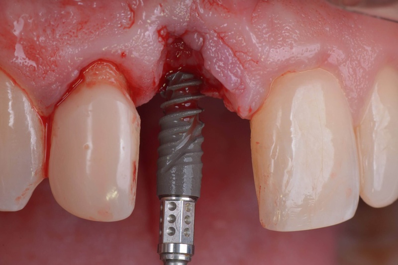 Trong trường hợp nghiêm trọng cần loại bỏ trụ Implant cũ thay bằng mới