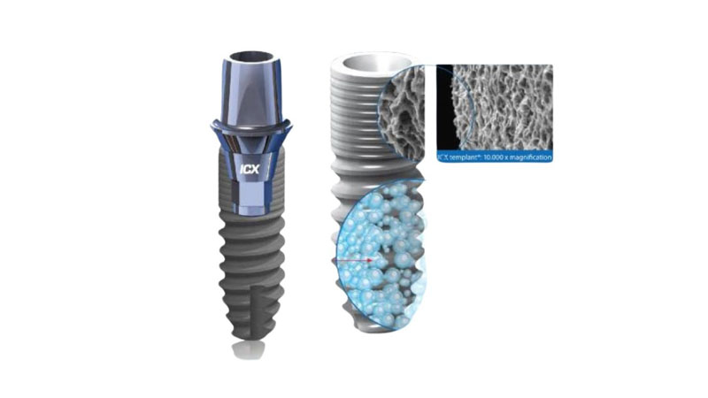 Ưu điểm nổi bật của trụ Implant ICX