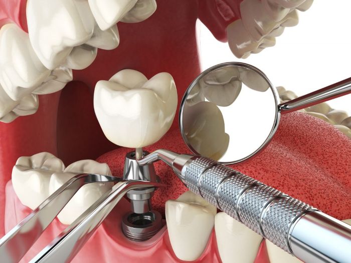 Trụ Implant không tích hợp - Nguyên nhân răng cắm Implant bị lung lay