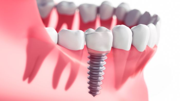 Trụ Implant Otex không được cấp phép bởi Bộ Y tế