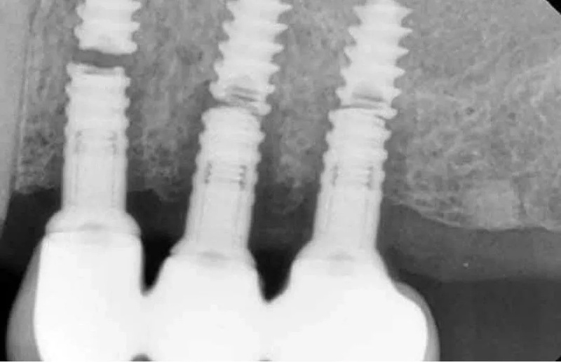 Trụ răng Implant bị gãy