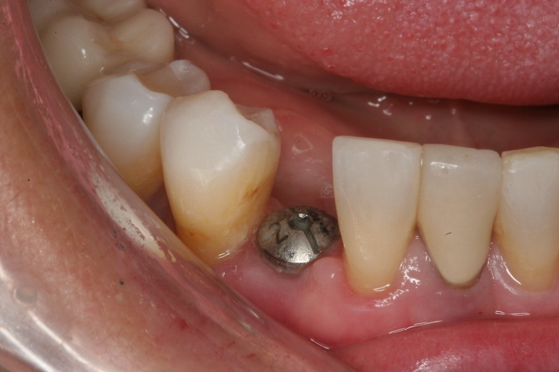 Vùng nướu quanh Implant có dấu hiệu sưng đỏ
