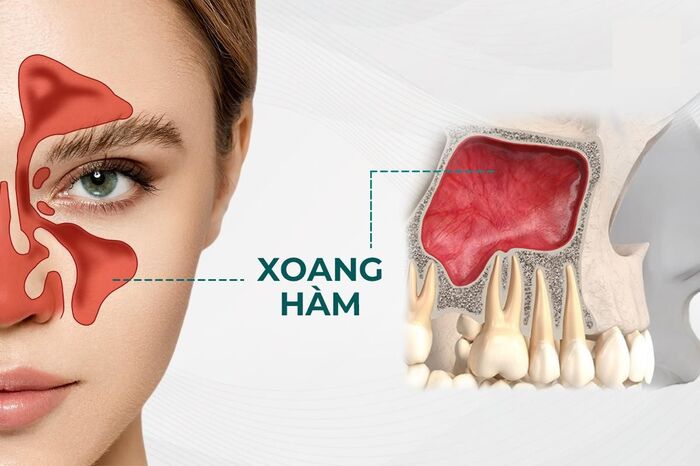 Xoang hàm