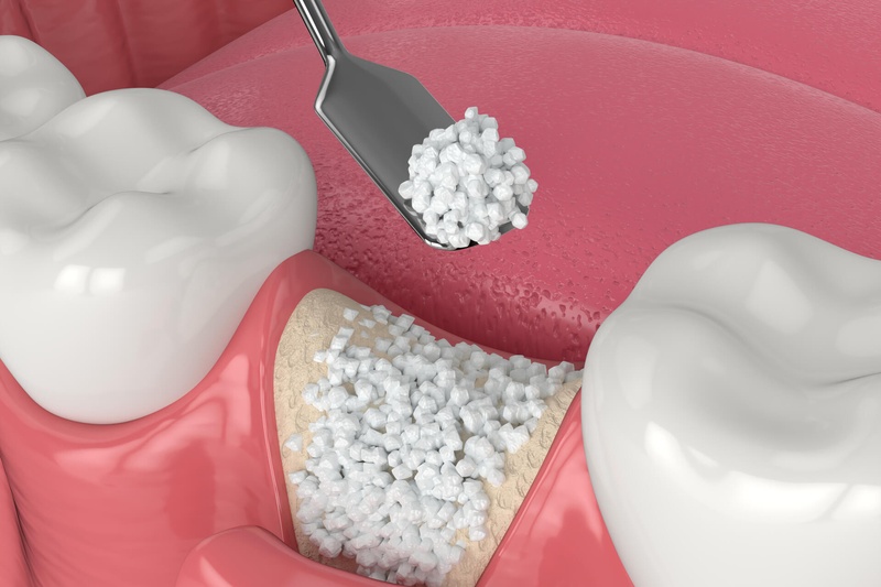 Xương nhân tạo trong nha khoa được sử dụng trong trường hợp cấy Implant bị thiếu xương