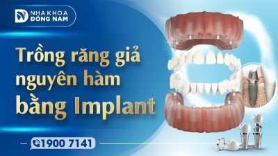 Trồng răng giả nguyên hàm bằng Implant