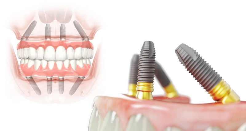 Trồng răng giả nguyên hàm phổ biến All On X giúp tiết kiệm chi phí