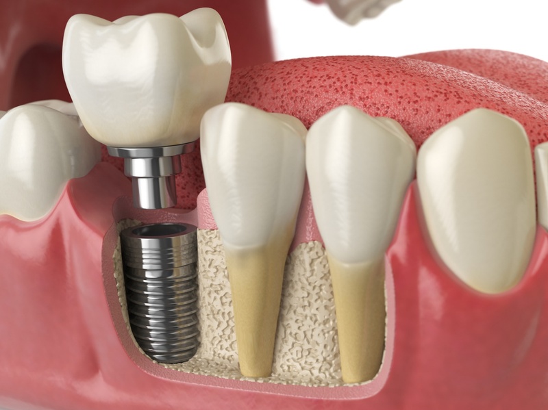 Trụ Implant ngăn ngừa tiêu xương hàm hiệu quả