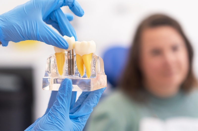 Trụ Neo Biotech phù hợp với người có chất lượng xương tốt