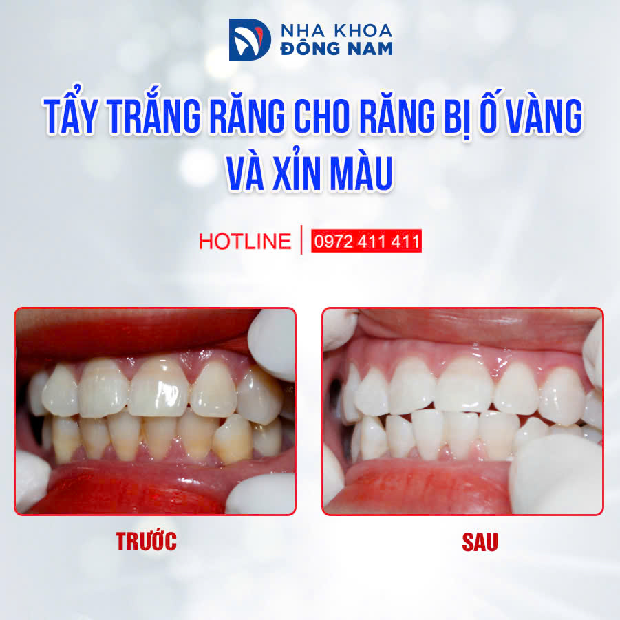 Trước và sau khi tẩy trắng răng - Case 2