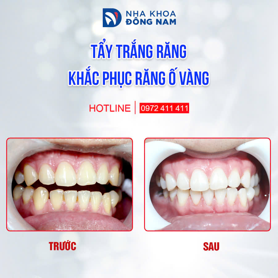 Trước và sau khi tẩy trắng răng - Case 1