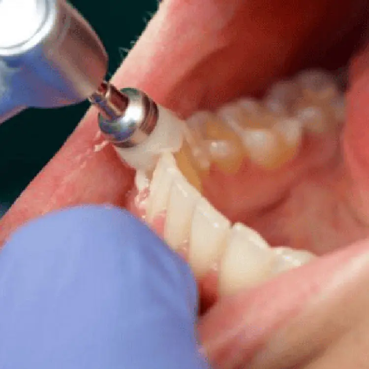 đánh bóng mặt răng và hướng dẫn chăm sóc