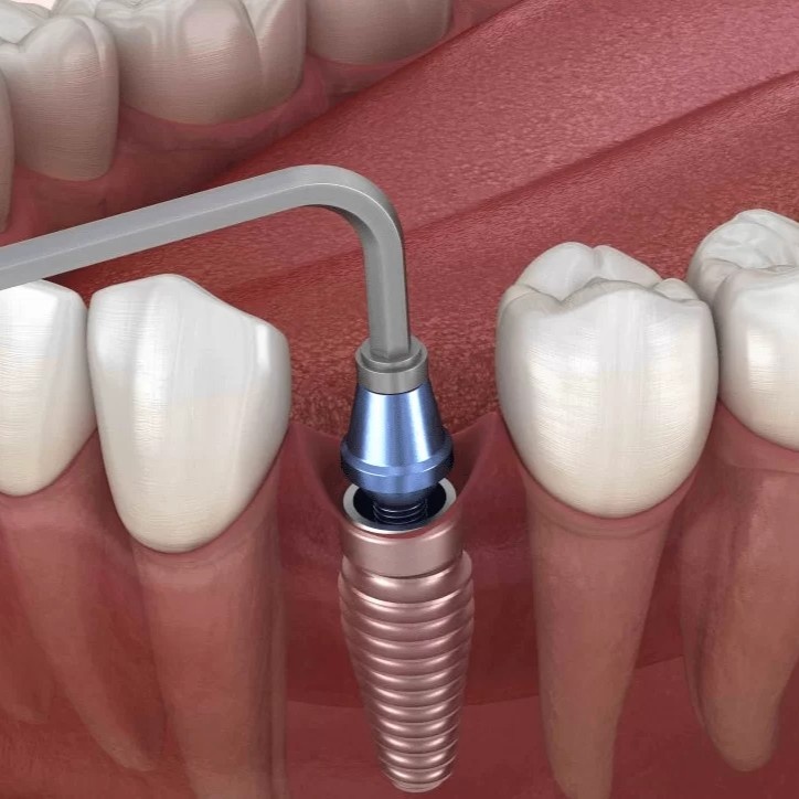 Lấy dấu răng sứ