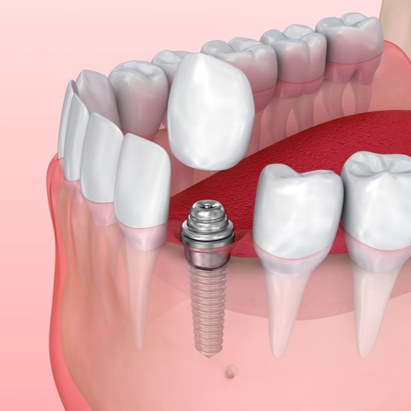 Hoàn tất phục hình
