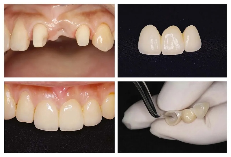 Cầu răng sứ áp dụng cho trường hợp mất 1 hoặc một vài răng liền kề