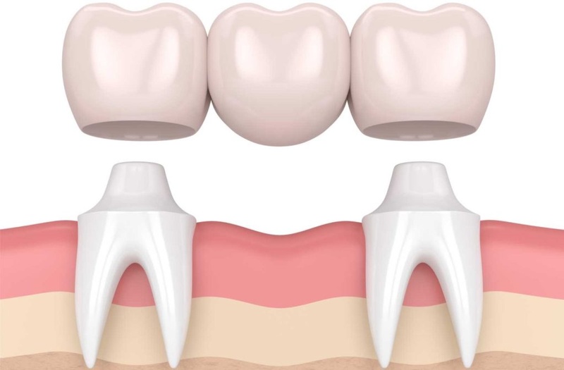 Cầu răng sứ truyền thống
