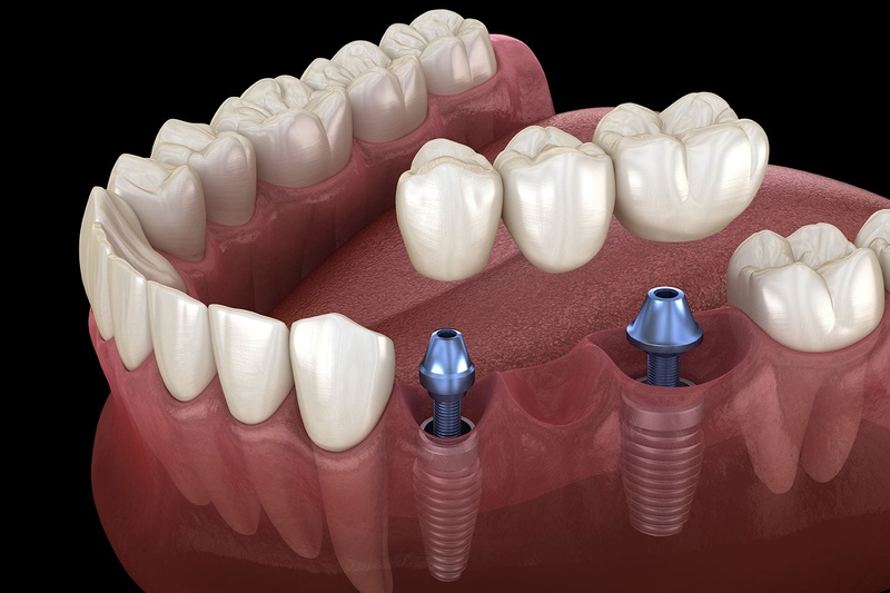 Kỹ thuật làm cầu răng sứ trên Implant