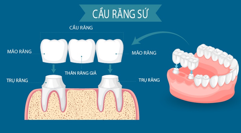 Kỹ thuật làm cầu răng sứ