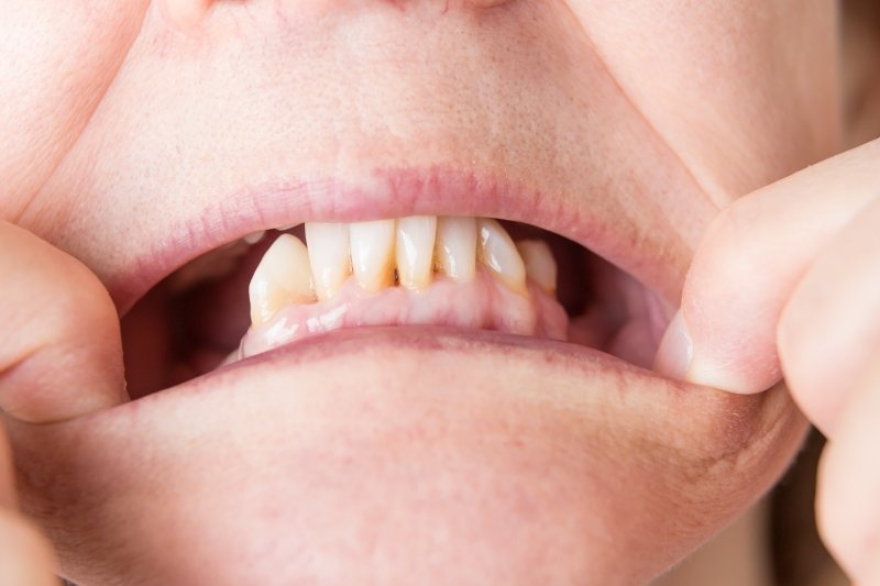 Mất răng quá nhiều không thể làm cầu răng sứ