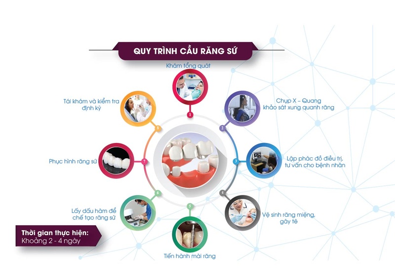 Quy trình làm cầu răng sứ chuẩn y khoa