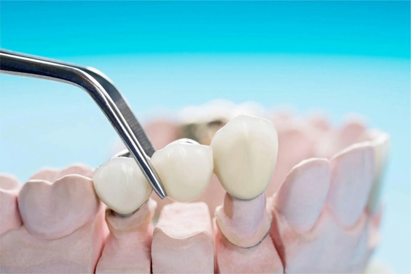 Tuổi thọ trung bình của cầu răng sứ khoảng 5 – 7 năm