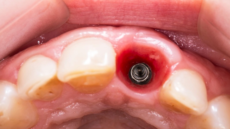 Biến chứng nguy hiểm của trồng răng Implant