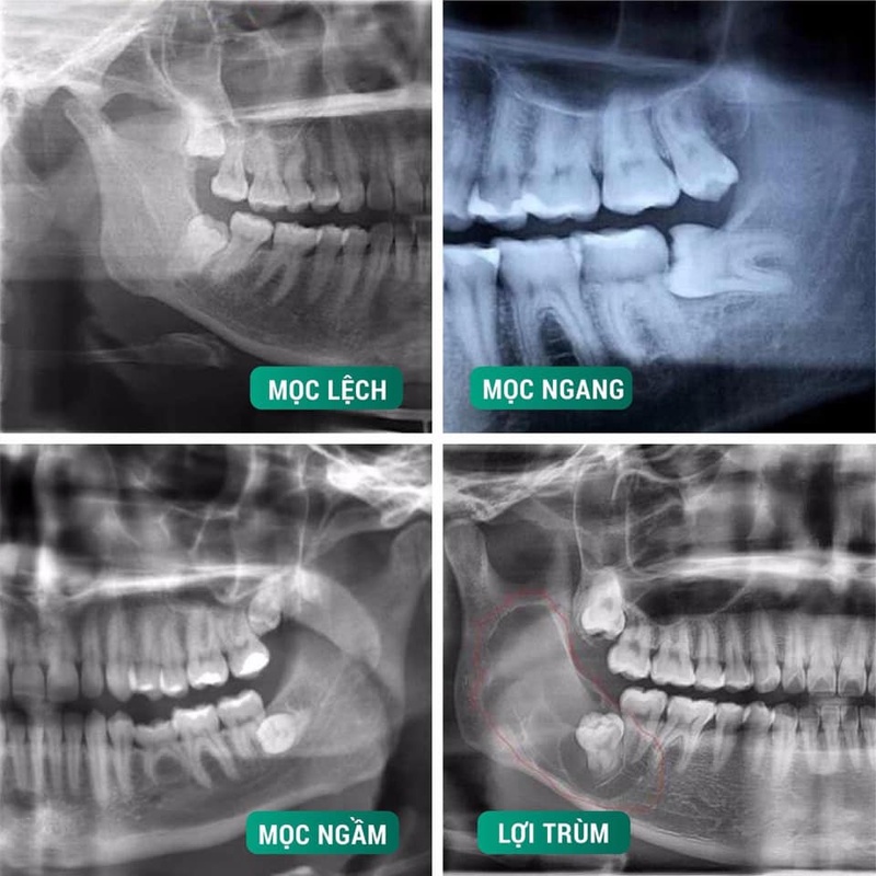 Các kiểu răng khôn mọc lệch thường gặp