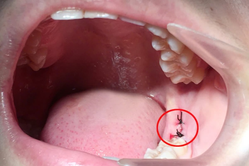 Nhổ răng khôn không đúng cách tiềm ẩn nhiều tác hại