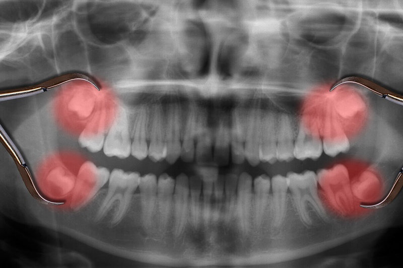 Răng khôn mọc lệch cần chỉ định nhổ bỏ để hạn chế biến chứng