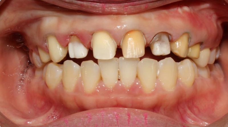 Làm mặt dán sứ giá rẻ có nguy cơ viêm nhiễm vùng nướu răng