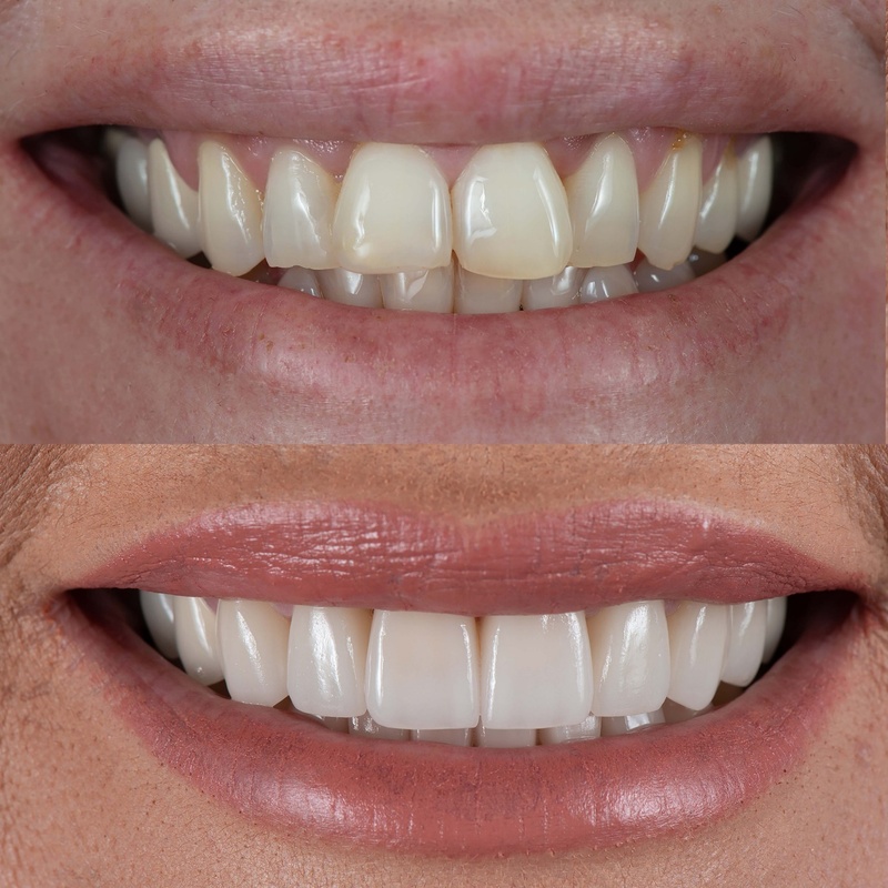 Mặt dán sứ cho màu sắc và hình dáng tự nhiên như răng thật